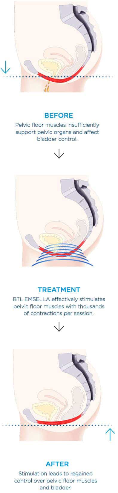 Before pelvic floor muscle affect bladder control, Treatment stimulate muscle, After regain control